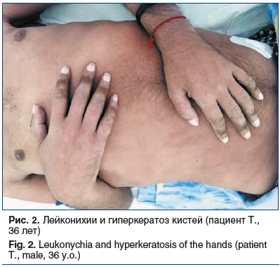 Рис. 2. Лейконихии и гиперкератоз кистей (пациент Т., 36 лет) Fig. 2. Leukonychia and hyperkeratosis of the hands (patient T., male, 36 y.o.)