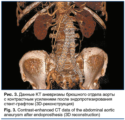 Рис. 3. Данные КТ аневризмы брюшного отдела аорты с контрастным усилением после эндопротезирования стент-графтом (3D-реконструкция) Fig. 3. Contrast-enhanced CT data of the abdominal aortic aneurysm after endoprosthesis (3D reconstruction)