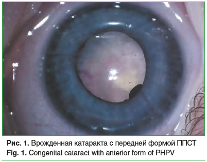 Рис. 1. Врожденная катаракта с передней формой ППСТ Fig. 1. Congenital cataract with anterior form of PHPV