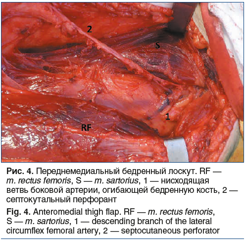 Рис. 4. Переднемедиальный бедренный лоскут. RF — m. rectus femoris, S — m. sartorius, 1 — нисходящая ветвь боковой артерии, огибающей бедренную кость, 2 — септокутальный перфорант Fig. 4. Anteromedial thigh flap. RF — m. rectus femoris, S — m. sartorius, 