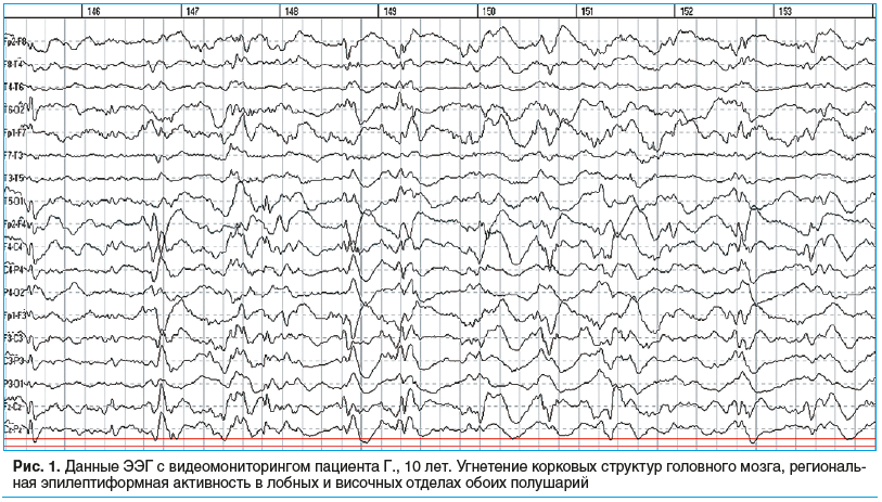 Индекс эпилептиформной активности. Эпилептиформная активность на ЭЭГ. ЭЭГ видеомониторинг. Региональная эпилептиформная активность у ребенка на ЭЭГ.
