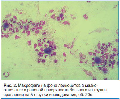 Рис. 2. Макрофаги на фоне лейкоцитов в мазке- отпечатке с раневой поверхности больного из группы сравнения на 5-е сутки исследования, об. 20х