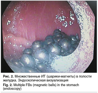 Рис. 2. Множественные ИТ (шарики-магниты) в полости желудка. Эндоскопическая визуализация Fig. 2. Multiple FBs (magnetic balls) in the stomach (endoscopy)