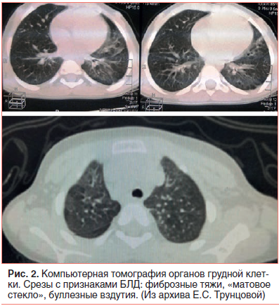 Рис. 2. Компьютерная томография органов грудной клетки. Срезы с признаками БЛД: фиброзные тяжи, «матовое стекло», буллезные вздутия. (Из архива Е.С. Трунцовой)