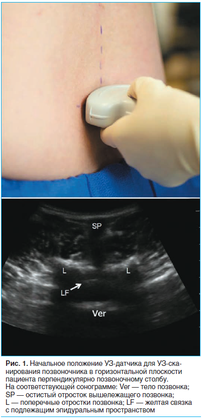 Рис. 1. Начальное положение УЗ-датчика для УЗ-сканирования позвоночника в горизонтальной плоскости пациента перпендикулярно позвоночному столбу.