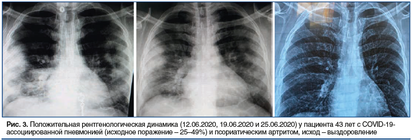 Рис. 3. Положительная рентгенологическая динамика (12.06.2020, 19.06.2020 и 25.06.2020) у пациента 43 лет с COVID-19- ассоциированной пневмонией (исходное поражение – 25–49%) и псориатическим артритом, исход – выздоровление