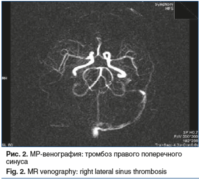Рис. 2. МР-венография: тромбоз правого поперечного синуса Fig. 2. MR venography: right lateral sinus thrombosis