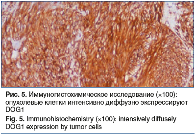 Рис. 5. Иммуногистохимическое исследование (×100): опухолевые клетки интенсивно диффузно экспрессируют DOG1 Fig. 5. Immunohistochemistry (×100): intensively diffusely DOG1 expression by tumor cells