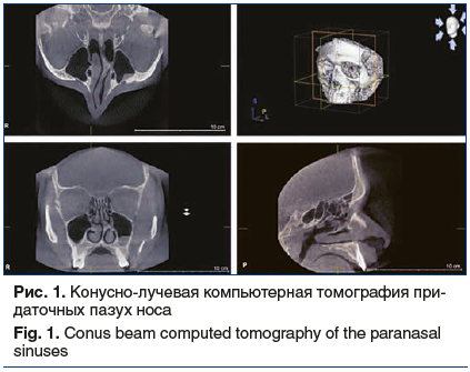 Рис. 1. Конусно-лучевая компьютерная томография при- даточных пазух носа Fig. 1. Conus beam computed tomography of the paranasal sinuses