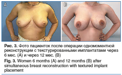 Рис. 3. Фото пациенток после операции одномоментной реконструкции с текстурированными имплантатами через 6 мес. (А) и через 12 мес. (В) Fig. 3. Women 6 months (A) and 12 months (B) after simultaneous breast reconstruction with textured implant placement