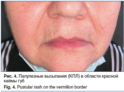 Рис. 4. Папулезные высыпания (КПЛ) в области красной каймы губ Fig. 4. Pustular rash on the vermilion border