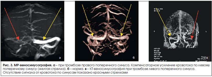 Гипоплазия правого поперечного синуса. Тромбоз поперечного синуса головного мозга на кт. Тромбоз поперечного сигмовидного синуса мрт. Тромбоз поперечного синуса кт. Тромбоз поперечного синуса головного.