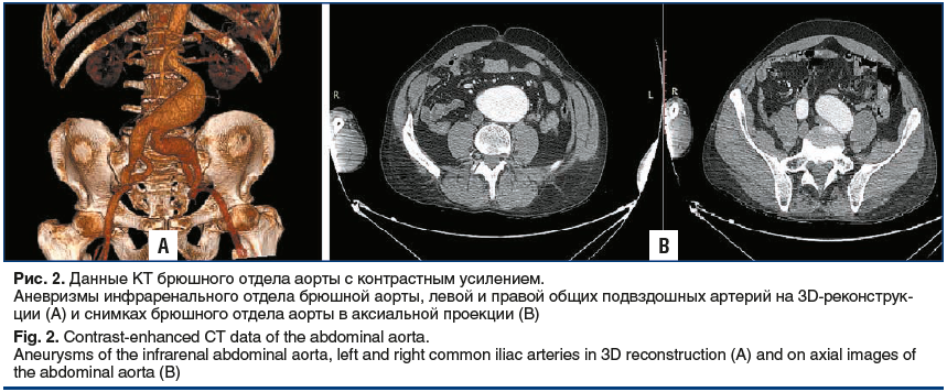 Рис. 2. Данные КТ брюшного отдела аорты с контрастным усилением. Аневризмы инфраренального отдела брюшной аорты, левой и правой общих подвздошных артерий на 3D-реконструкции (A) и снимках брюшного отдела аорты в аксиальной проекции (B) Fig. 2. Contrast-en