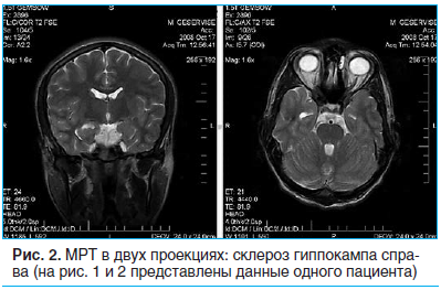 Рис. 2. МРТ в двух проекциях: склероз гиппокампа справа (на рис. 1 и 2 представлены данные одного пациента)