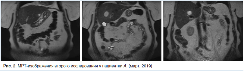 Рис. 2. МРТ-изображения второго исследования у пациентки А. (март, 2019)