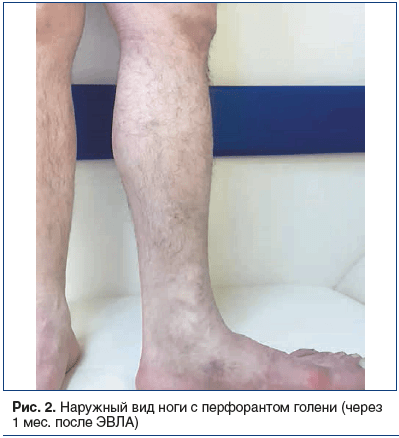 Рис. 2. Наружный вид ноги с перфорантом голени (через 1 мес. после ЭВЛА)