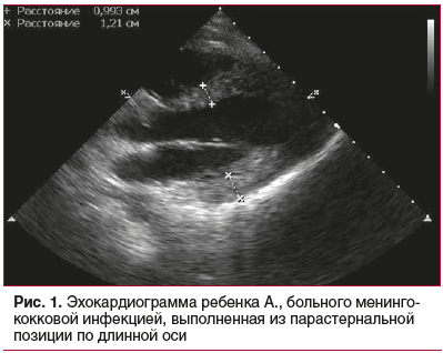 Рис. 1. Эхокардиограмма ребенка А., больного менингококковой инфекцией, выполненная из парастернальной позиции по длинной оси