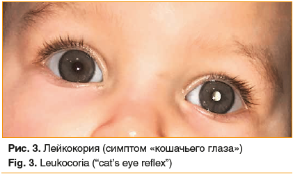 Рис. 3. Лейкокория (симптом «кошачьего глаза») Fig. 3. Leukocoria (“cat’s eye reflex”)