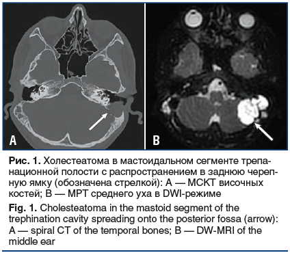 Рис. 1. Холестеатома в мастоидальном сегменте трепа- национной полости c распространением в заднюю череп- ную ямку (обозначена стрелкой): A — МСКТ височных костей; B — МРТ среднего уха в DWI-режиме Fig. 1. Cholesteatoma in the mastoid segment of the treph