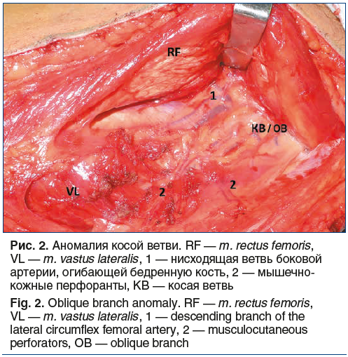 Рис. 2. Аномалия косой ветви. RF — m. rectus femoris, VL — m. vastus lateralis, 1 — нисходящая ветвь боковой артерии, огибающей бедренную кость, 2 — мышечно- кожные перфоранты, КВ — косая ветвь Fig. 2. Oblique branch anomaly. RF — m. rectus femoris, VL — 