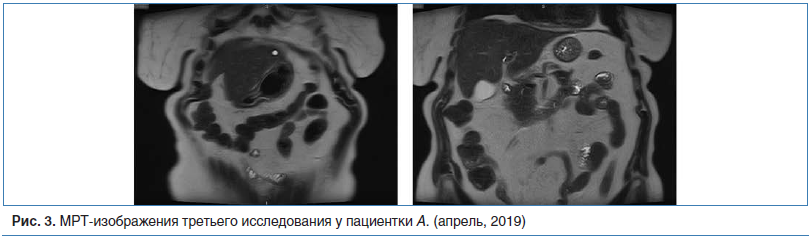 Рис. 3. МРТ-изображения третьего исследования у пациентки А. (апрель, 2019)
