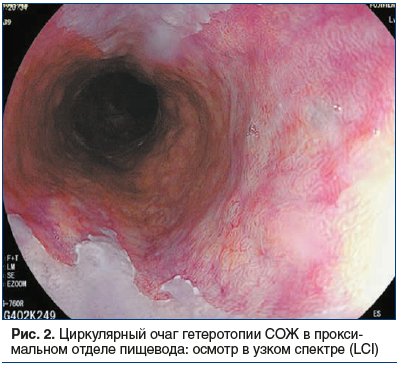 Рис. 2. Циркулярный очаг гетеротопии СОЖ в проксимальном отделе пищевода: осмотр в узком спектре (LCI)