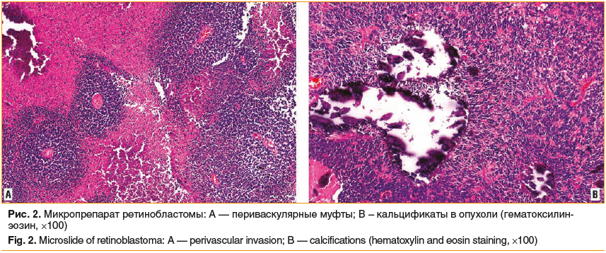 Рис. 2. Микропрепарат ретинобластомы: А — периваскулярные муфты; В – кальцификаты в опухоли (гематоксилин- эозин, ×100) Fig. 2. Microslide of retinoblastoma: A — perivascular invasion; B — calcifications (hematoxylin and eosin staining, ×100)