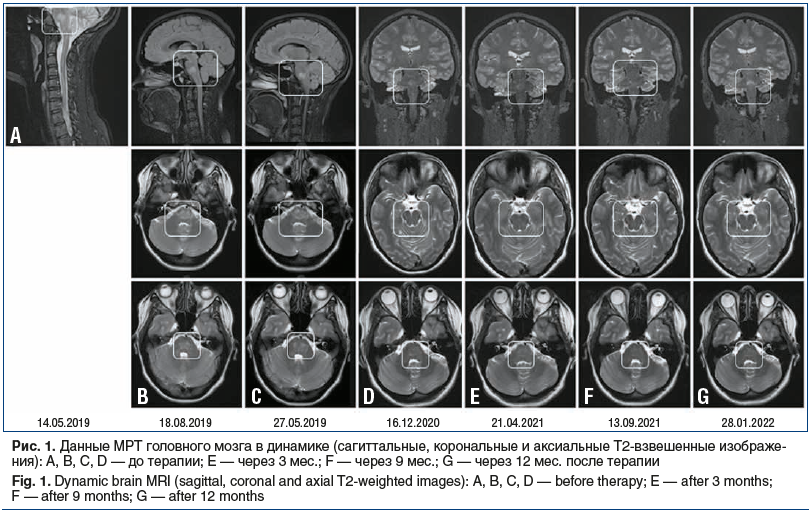 Рис. 1. Данные МРТ головного мозга в динамике (сагиттальные, корональные и аксиальные Т2-взвешенные изображе- ния): A, B, C, D — до терапии; E — через 3 мес.; F — через 9 мес.; G — через 12 мес. после терапии Fig. 1. Dynamic brain MRI (sagittal, coronal a