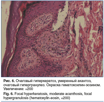 Рис. 6. Очаговый гиперкератоз, умеренный акантоз, очаговый гипергранулез. Окраска гематоксилин-эозином. Увеличение: ×200 Fig. 6. Focal hyperkeratosis, moderate acanthosis, focal hypergranulosis (hematoxylin-eosin, ×200)