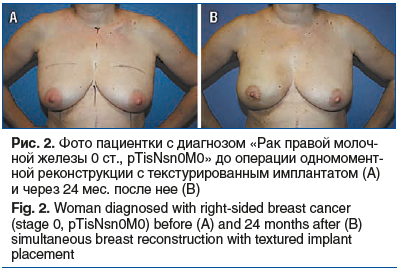 Рис. 2. Фото пациентки с диагнозом «Рак правой молоч- ной железы 0 ст., pTisNsn0M0» до операции одномомент- ной реконструкции с текстурированным имплантатом (А) и через 24 мес. после нее (В) Fig. 2. Woman diagnosed with right-sided breast cancer (stage 0,