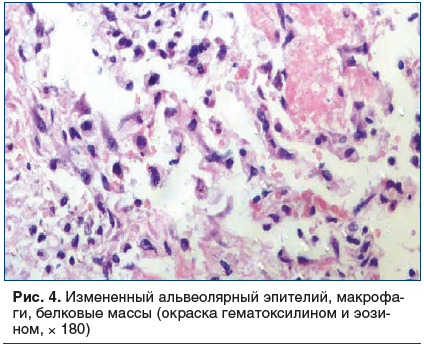 Рис. 4. Измененный альвеолярный эпителий, макрофаги, белковые массы (окраска гематоксилином и эозином, × 180)