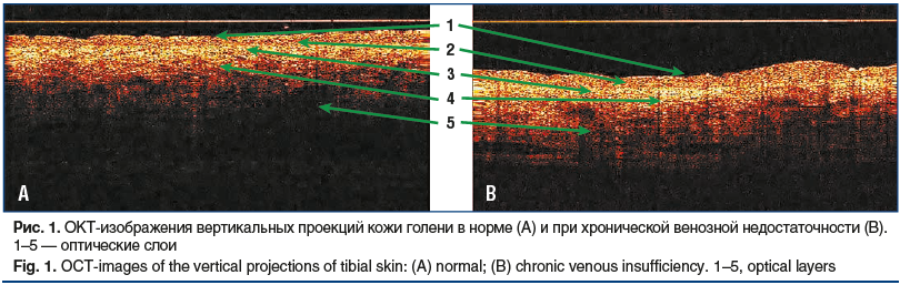 Рис. 1. ОКТ-изображения вертикальных проекций кожи голени в норме (A) и при хронической венозной недостаточности (B). 1–5 — оптические слои Fig. 1. OCT-images of the vertical projections of tibial skin: (A) normal; (B) chronic venous insufficiency. 1–5, o