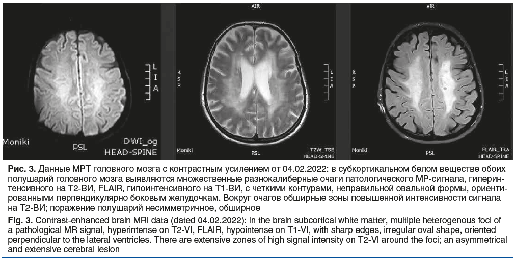 Рис. 3. Данные МРТ головного мозга с контрастным усилением от 04.02.2022: в субкортикальном белом веществе обоих полушарий головного мозга выявляются множественные разнокалиберные очаги патологического МР-сигнала, гиперин- тенсивного на Т2-ВИ, FLAIR, гипо