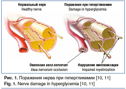 Рис. 1. Поражения нерва при гипергликемии [10, 11] Fig. 1. Nerve damage in hyperglycemia [10, 11]