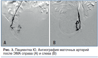Рис. 3. Пациентка Ю. Ангиография маточных артерий после ЭМА справа (А) и слева (В)