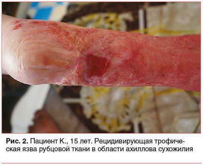 Рис. 2. Пациент К., 15 лет. Рецидивирующая трофическая язва рубцовой ткани в области ахиллова сухожилия