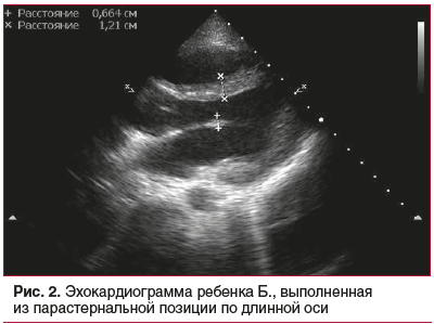 Рис. 2. Эхокардиограмма ребенка Б., выполненная из парастернальной позиции по длинной оси