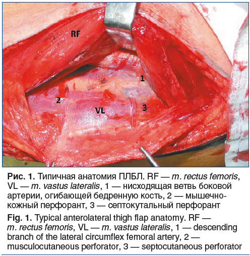 Рис. 1. Типичная анатомия ПЛБЛ. RF — m. rectus femoris, VL — m. vastus lateralis, 1 — нисходящая ветвь боковой артерии, огибающей бедренную кость, 2 — мышечно- кожный перфорант, 3 — септокутальный перфорант Fig. 1. Typical anterolateral thigh flap anatomy