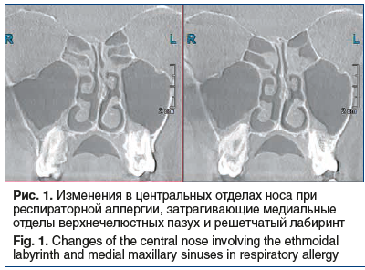Рис. 1. Изменения в центральных отделах носа при респираторной аллергии, затрагивающие медиальные отделы верхнечелюстных пазух и решетчатый лабиринт Fig. 1. Changes of the central nose involving the ethmoidal labyrinth and medial maxillary sinuses in resp