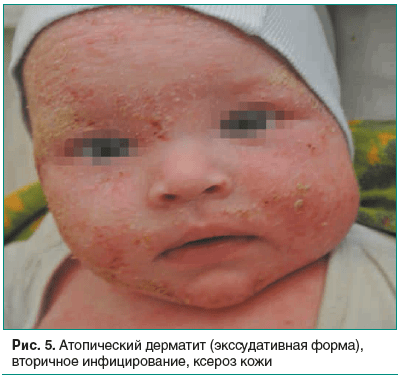 Рис. 5. Атопический дерматит (экссудативная форма), вторичное инфицирование, ксероз кожи