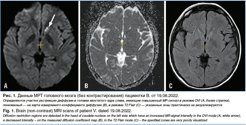 Рис. 1. Данные МРТ головного мозга (без контрастирования) пациентки В. от 19.08.2022. Определяются участки рестрикции диффузии в головке хвостатого ядра слева, имеющие повышенный МР-сигнал в режиме DVI (A, белая стрелка), пониженный — на карте измеряемого