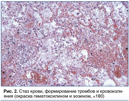 Рис. 2. Стаз крови, формирование тромбов и кровоизлияния (окраска гематоксилином и эозином, ×180)