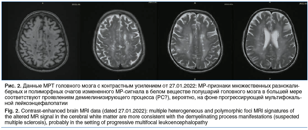 Рис. 2. Данные МРТ головного мозга с контрастным усилением от 27.01.2022: МР-признаки множественных разнокали- берных и полиморфных очагов измененного МР-сигнала в белом веществе полушарий головного мозга в большей мере соответствуют проявлениям демиелини