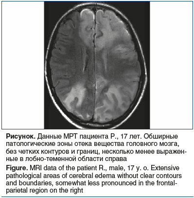 Рисунок. Данные МРТ пациента Р., 17 лет. Обширные патологические зоны отека вещества головного мозга, без четких контуров и границ, несколько менее выражен- ные в лобно-теменной области справа Figure. MRI data of the patient R., male, 17 y. o. Extensive p