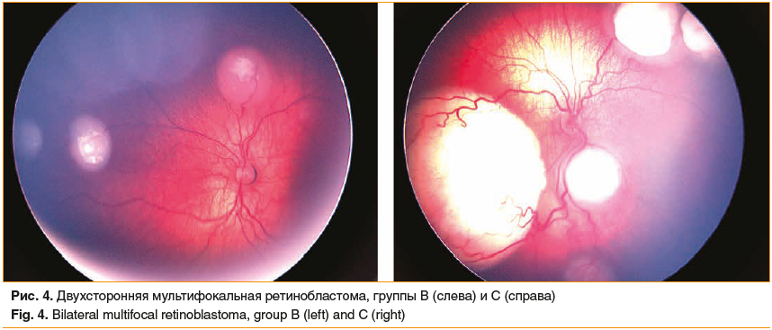 Рис. 4. Двухсторонняя мультифокальная ретинобластома, группы В (слева) и С (справа) Fig. 4. Bilateral multifocal retinoblastoma, group B (left) and C (right)