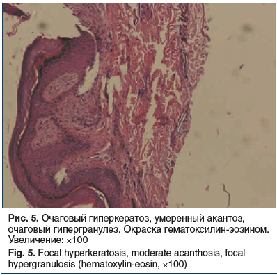 Рис. 5. Очаговый гиперкератоз, умеренный акантоз, очаговый гипергранулез. Окраска гематоксилин-эозином. Увеличение: ×100 Fig. 5. Focal hyperkeratosis, moderate acanthosis, focal hypergranulosis (hematoxylin-eosin, ×100)