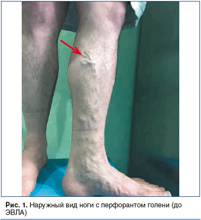 Рис. 1. Наружный вид ноги с перфорантом голени (до ЭВЛА)