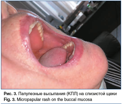 Рис. 3. Папулезные высыпания (КПЛ) на слизистой щеки Fig. 3. Micropapular rash on the buccal mucosa