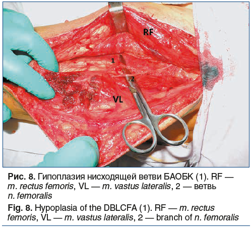 Рис. 8. Гипоплазия нисходящей ветви БАОБК (1). RF — m. rectus femoris, VL — m. vastus lateralis, 2 — ветвь n. femoralis Fig. 8. Hypoplasia of the DBLCFA (1). RF — m. rectus femoris, VL — m. vastus lateralis, 2 — branch of n. femoralis