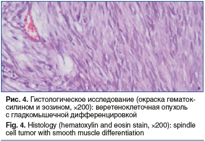 Рис. 4. Гистологическое исследование (окраска гематок- силином и эозином, ×200): веретеноклеточная опухоль с гладкомышечной дифференцировкой Fig. 4. Histology (hematoxylin and eosin stain, ×200): spindle cell tumor with smooth muscle differentiation